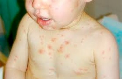 Chicken Pox in Merida Yucatan Mexico <a href=></a>